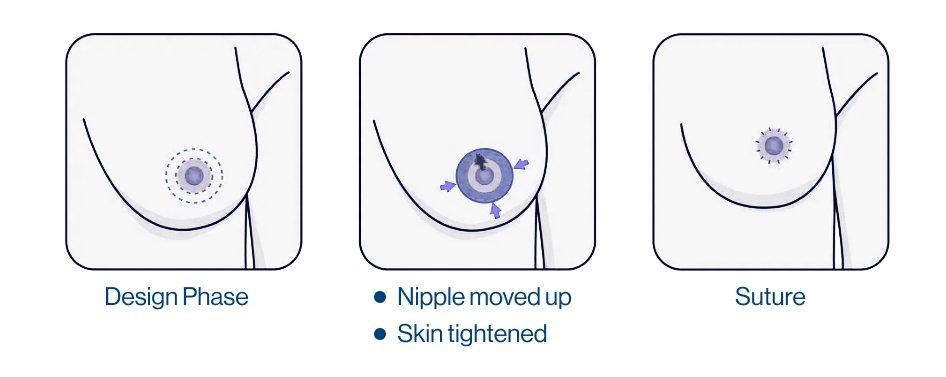 Nipple Reduction Surgery, Areola Reduction Surgery