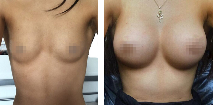 Breast Enlargement London (16).png