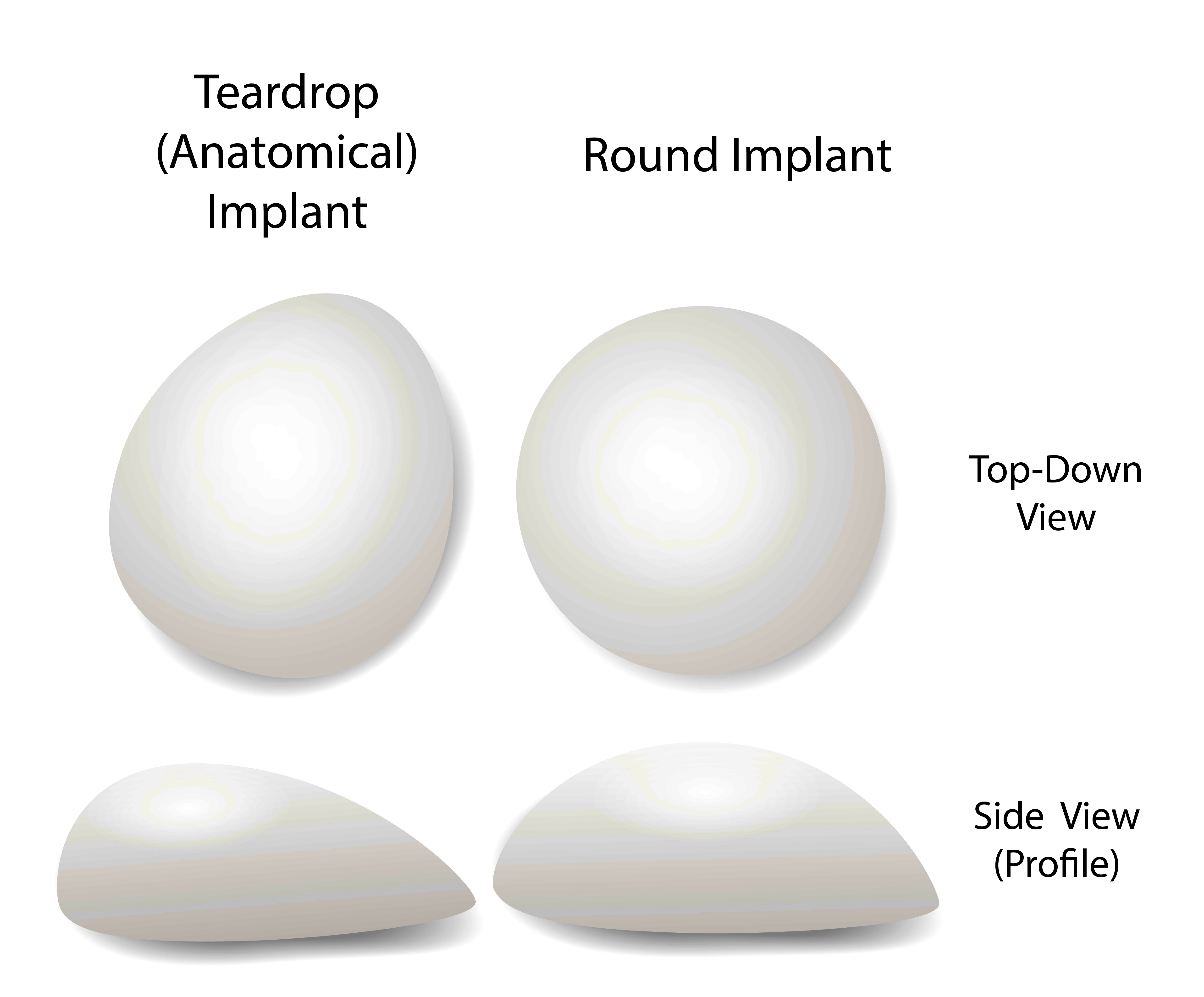 Size of Breast Implants - Male to female transsexual talk (MTF) - Susan's  Place Transgender Resources
