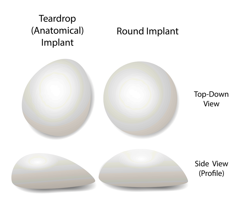 Breast implant shapes types breast enlargement.png