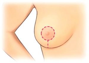 Crescent Incision Technique 4