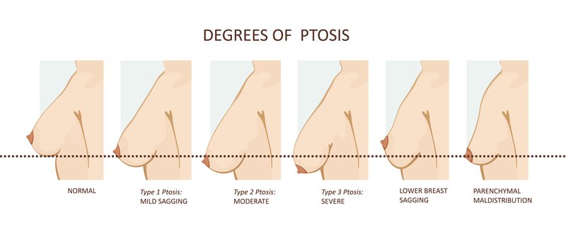 degree of ptosis in breasts