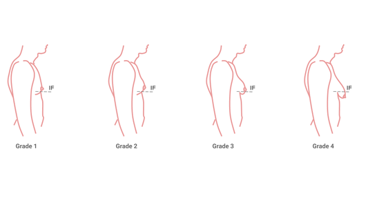 gynaecomastia