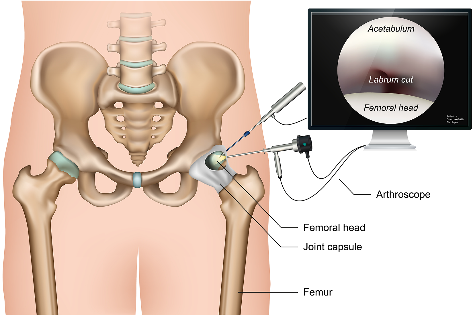Hip Arthroscopy Surgery Cost and Procedure Information