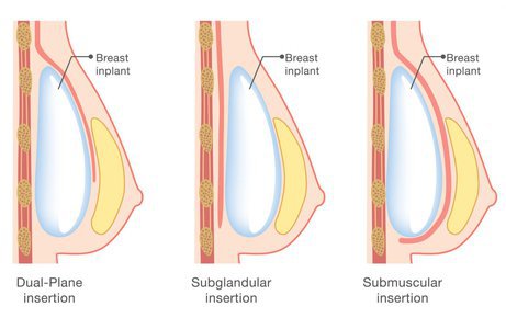 Breast Enlargement for Gender Affirmation Surgery Guide