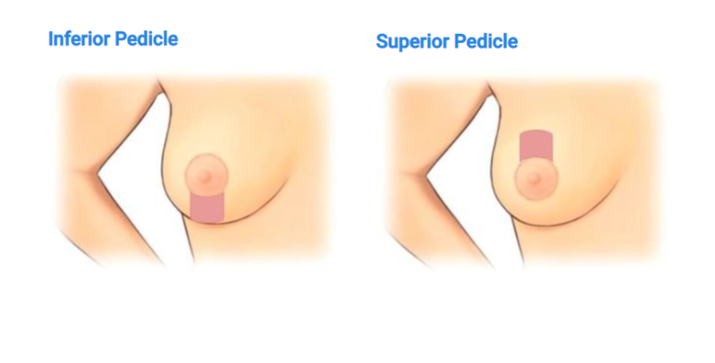 inferior pedicle superior pedicle.png