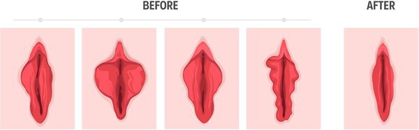 How To Shrink Your Labia Without Surgery 
