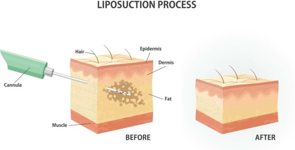 liposuction.jpg