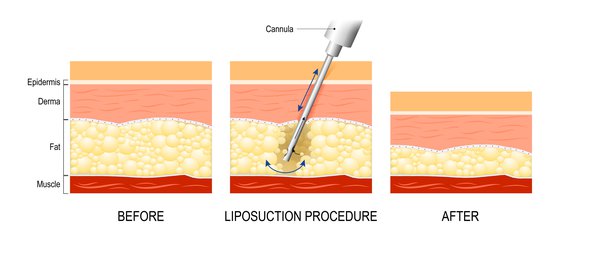 liposuction for fat transfer breast enlargement