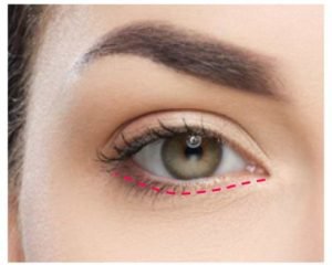 lower-eyelid-1.jpg