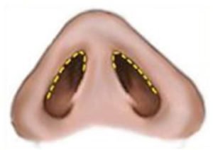 lower-eyelid-3-1.jpg