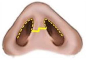 lower-eyelid-4-1.jpg