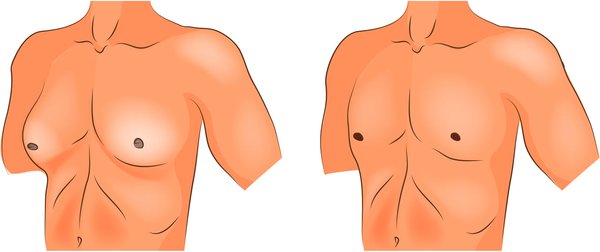 male breast reduction