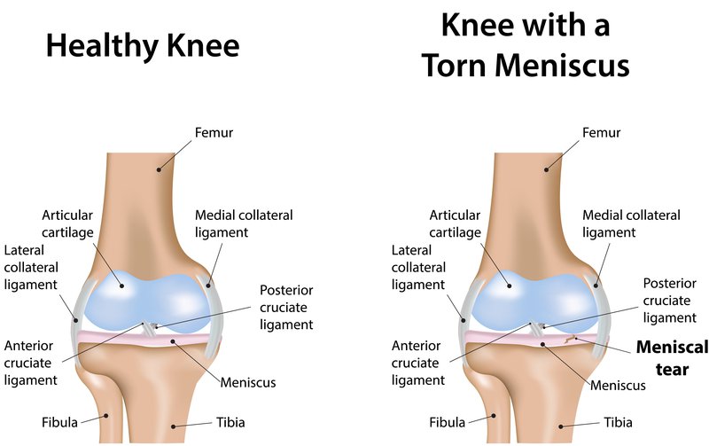 Meniscal Repair Surgery Cost Price Advice Before After Images And Videos Medbelle