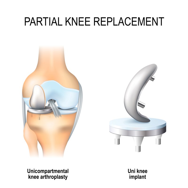 partial_knee_replacement_surgery_procedure