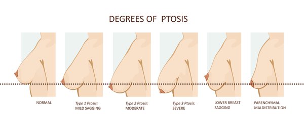 Degrees of Ptosis