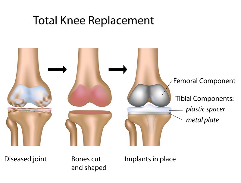 total_knee_replacement_procedure_surgery
