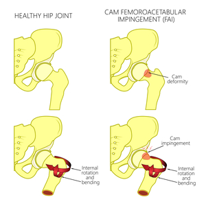 Hip Conditions: Femoroacetabular Impingement (FAI)