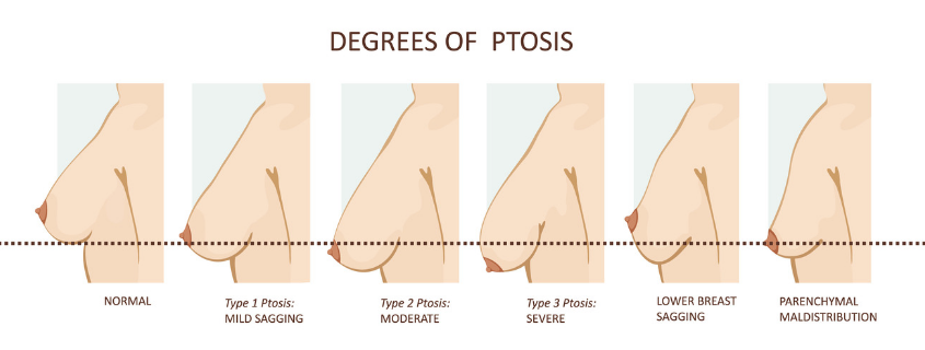 Breast Enlargement Augmentation Surgery Price Guide