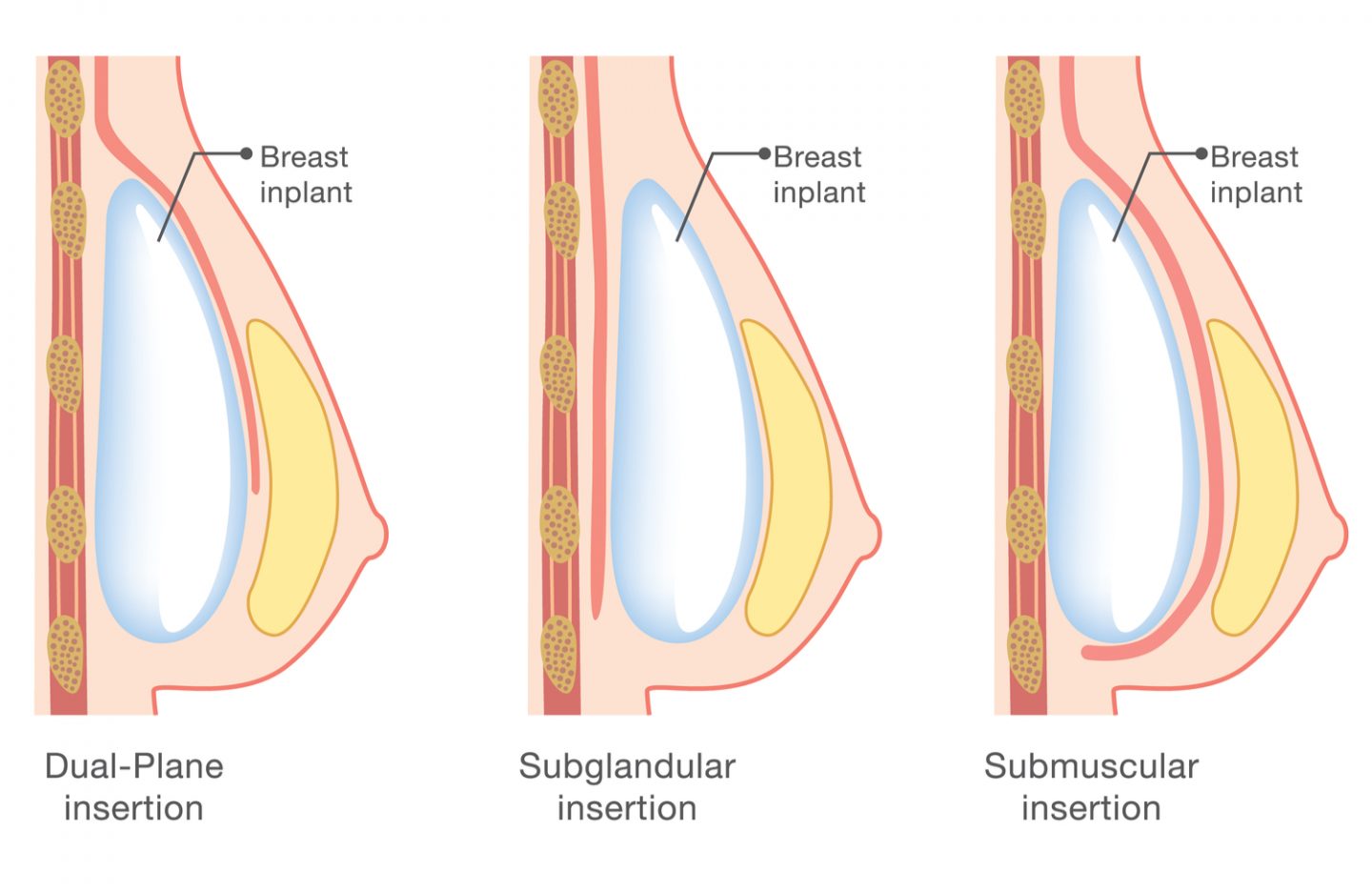 Breast Enlargement in London with Medbelle