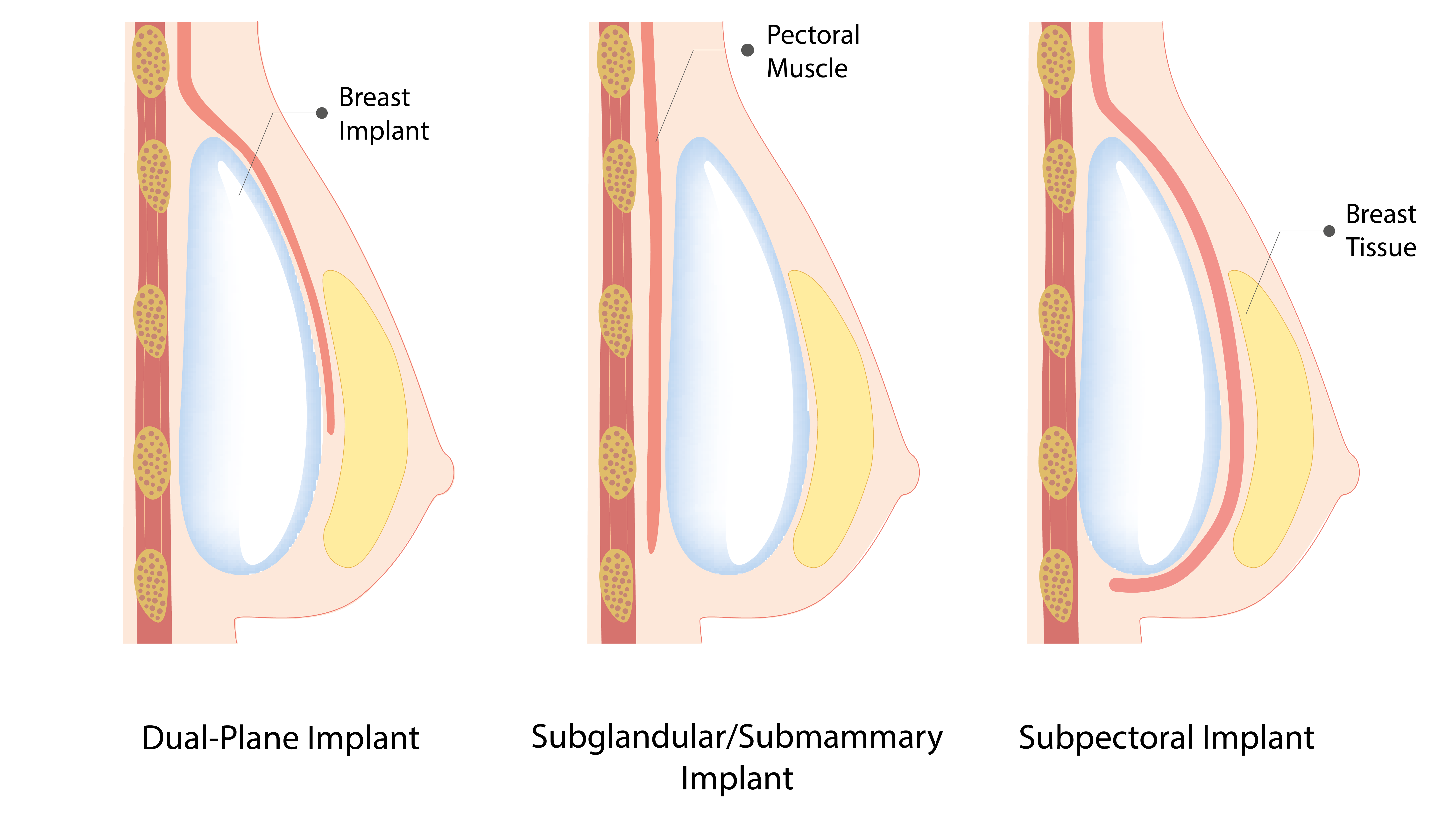 What Is Breast Augmentation & What Are The Different Types? Luxor
