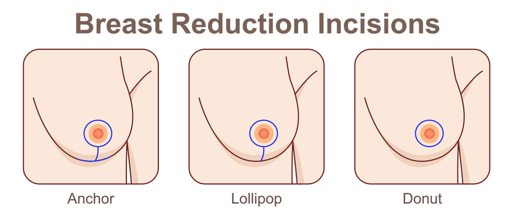 Breast Reduction (Reduction Mammoplasty) Surgery Information