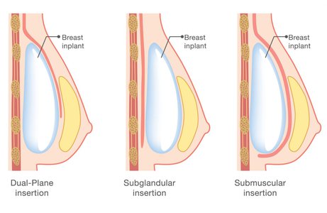 Breast Enlargement Uplift Surgery Cost Guide